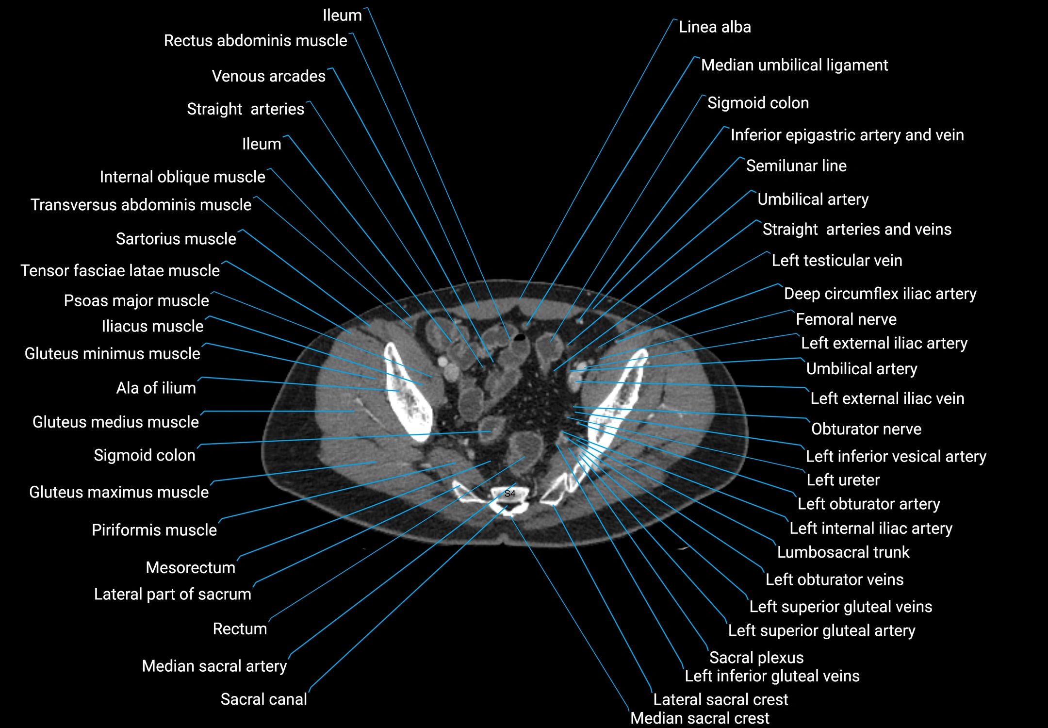 CT male pelvis axial cross sectional anatomy labelled radiology image -00166.webp